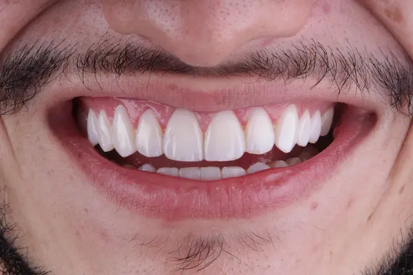 Antes depois 1 1
