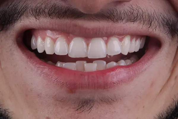 Antes depois 2 1