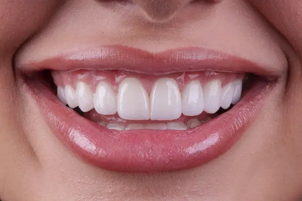 Lentes de contato ou faceta dental: qual a melhor opção? 1 antes depois 1